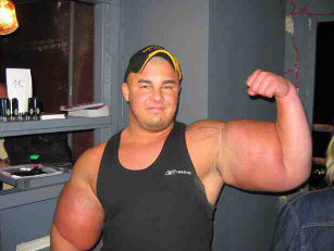 Hombre con bíceps de Synthol